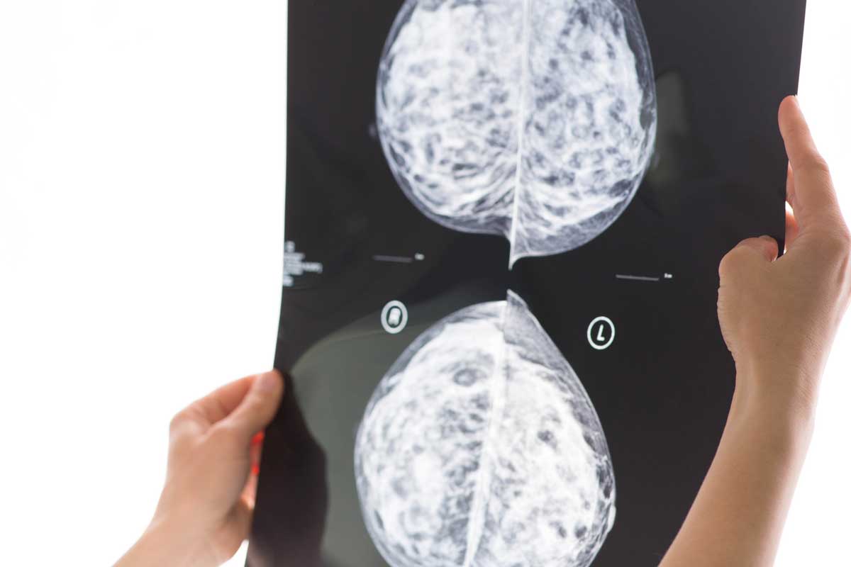 x-ray of breast tissue