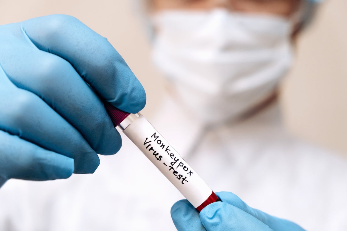 A medical worker holds a test tube with Monkeypox virus infected blood sample in his hands,hands in gloves close-up.Epidemic of smallpox monkeys in Europe and the USA.